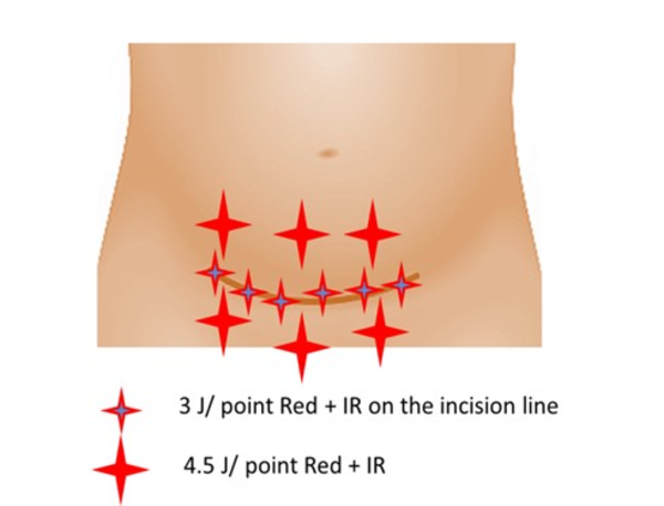 The points and locations irradiated in patients