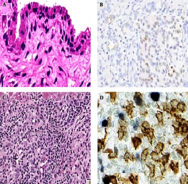 Immunohistochemical staining of CD163 on synovium biopsy (A, B), monoclonal antibody expression of CD163 in healthy control synovium; (C, D), monoclonal antibody expression of CD163 in the synovium of OA patients