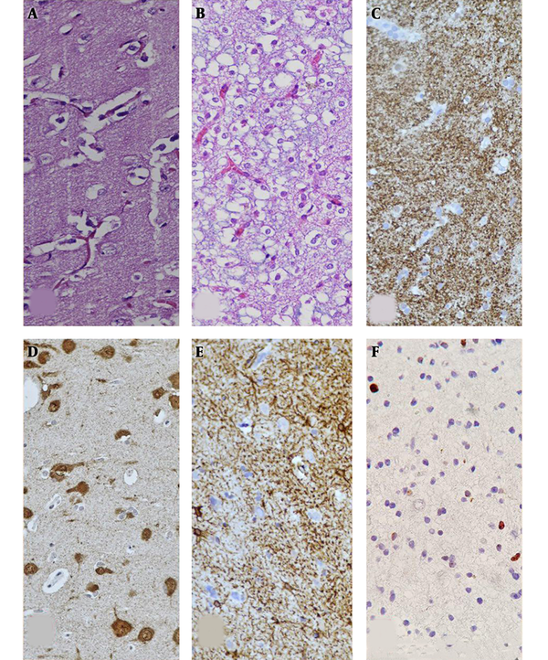 The H&E staining of the left temporal lesion revealed oligodendroglial-like cells, while tumoral cells had round uniform nuclei, which in some foci surrounded neuronal cells (A and B). Additional immunohistochemical findings: synaptophysin immunostain (C), neuronal glial (D), fibrillary acidic protein (GFAP) immunostain (E), and Ki-67 immunostain (F).