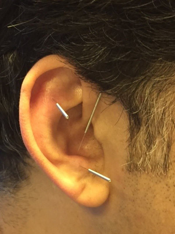 Ear points associated with pain relief used for acupuncture in intervention group