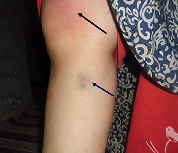 A 16 year old girl who was stung two times by a velvet ant. Note the early stages and redness of the sting (up arrow) on her knee, 3 minutes after sting, and the last stages of sting site (down arrow) on her foreleg, upper 5 days after sting.