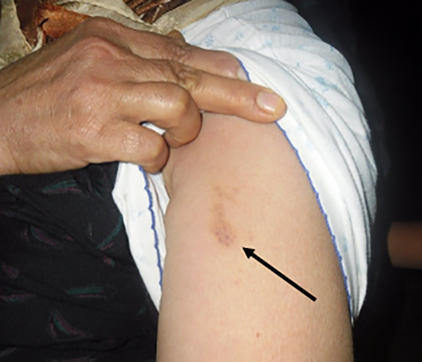 A 55 year old woman who was stung by velvet ant. Note the last stages of the sting site on her arm.