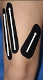 Does the Kinesio Tape Provide more Knee Extensor Torque?