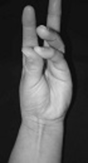 Incidence of Palmaris Longus Agenesis in the Young Iranian Population