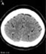 Clinical and Radiological Manifestations of Cerebral Venous Thrombosis: Are There Any Differences According to Presence or Absence of Cortical Vein Involvement?