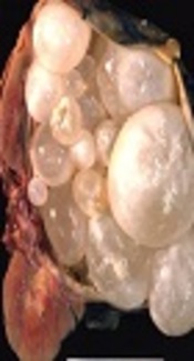 Kidney Hydatid cyst, Cedars-Sinai