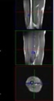 Diffusion-Weighted Imaging and Proton Magnetic Resonance Spectroscopy Findings in Osteosarcoma Versus Normal Muscle