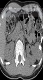 Imaging Findings of Retroperitoneal Primary Extraskeletal Mesenchymal Chondrosarcoma: A Case Report