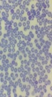 Relapse of a Plasmodium vivax Infection in an Iranian Patient: A Case Report