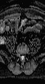 Contribution of Diffusion-Weighted Magnetic Resonance Imaging in the Follow-Up of Uncomplicated Acute Appendicitis: Initial Results