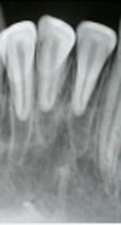 Pulp Revascularization Following Severe Extrusive Luxation Injury in Mature Permanent Mandibular Incisors: A Case Report