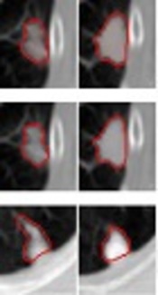 Segmentation Refinement of Small-Size Juxta-Pleural Lung Nodules in CT Scans