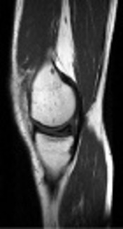 Accuracy of Magnetic Resonance Imaging in Identifying the Configuration of Meniscus Tears