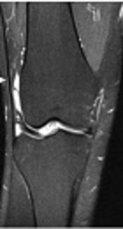 Association of Iliotibial Band Friction Syndrome with Patellar Height and Facets Variations: A Magnetic Resonance Imaging Study