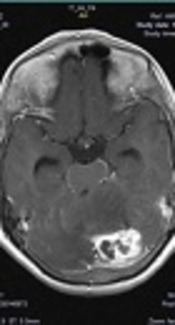 Cerebellar Mucormycosis in a Young Man: A Case Report