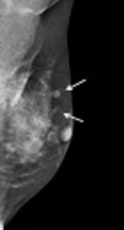 Multimodality Imaging of Charcoal Granuloma Mimicking Breast Cancer Recurrence