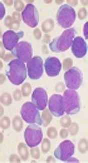 https://en.wikipedia.org/wiki/Acute_lymphoblastic_leukemia