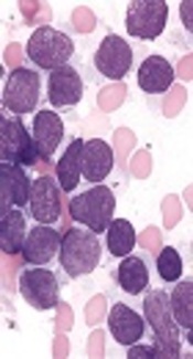 https://imagebank.hematology.org/image/2281/precursor-tcell-acute-lymphoblastic-leukemia--4?type=upload