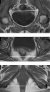 Effect of Sickle Cell Anemia on Pelvic Dimensions: A Magnetic Resonance Imaging Study