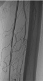 Endovascular Treatment with Drug-Coated Balloons in Femoropopliteal Artery Disease