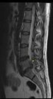 Chronic Low Back Pain in Young Population: An MRI Study