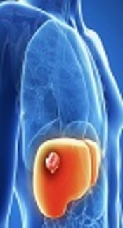 Hepatocellular Carcinoma is an Emerging Issue Now in Iran