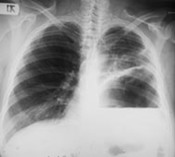 A Potentially Fatal Error in Diagnosis of a Pulmonary Hydatid Cyst