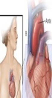 Coronary Artery Calcium Score Assessment, Mayo Clinic