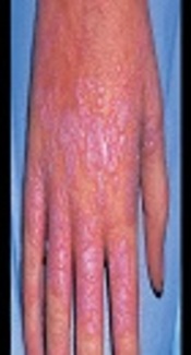 The Association of Cutaneous Lichen Planus and Metabolic Syndrome: A Case-Control Study