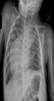 Coil Closure of Isolated Aortopulmonary Collaterals in an Infant Presenting with Recurrent Lower Respiratory Tract Infection