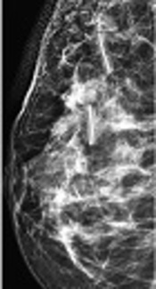 Accuracy Assessment of Surgical Clip Marker/Wire Localization in Advanced Breast Cancer
