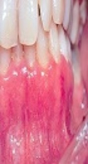 A Challenging in Diagnosis of Mucous Membrane Pemphigoid with Desquamative Gingivitis Presentation: A Case Report