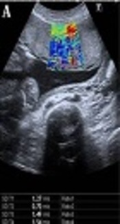 Evaluation of a Healthy Pregnant Placenta with Shear Wave Elastography