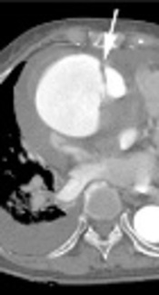 Different CT Findings of Aortic Hemorrhage Extending to Pulmonary Artery from Stanford Type A Aortic Dissection