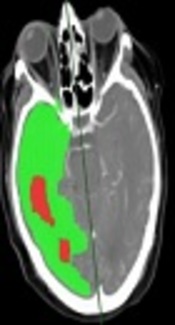 Status Epilepticus, Hemispheric Confusion, a CT Perfusion Pitfall in “Code Stroke” Patients: A Case Report