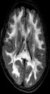 Metronidazole Induced Encephalopathy: A Case Report Showing Devastating Course on Consecutive MR Imaging