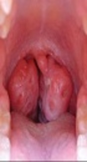 The Impact of Tonsillectomy Upon Respiratory Tract Infections