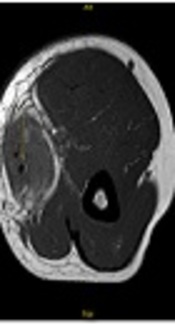 An MRI Investigation of Kimura Disease (KD) in Upper Extremity Soft Tissues: Two Case Reports