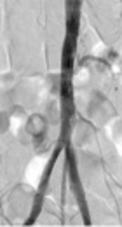 Endovascular Treatment Showing Promising Short-Term Results in Patients with Total Bilateral Aortoiliac Occlusion
