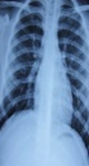 Papillary Thyroid Carcinoma Masquerading Miliary Tuberculosis