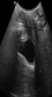 Agreement of Ultrasound Measures with POP-Q in Patients with Pelvic Organ Prolapse