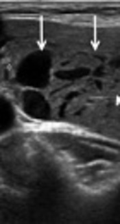 Contributory Factors to Hemorrhage After Ultrasound-Guided Fine Needle Aspiration of Thyroid Nodules with an Emphasis on Patients Taking Antithrombotic or Anticoagulant Medications