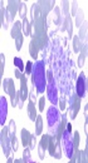 Familial Hemophagocytic Lymphohistiocytosis Type 3: Early Disease Onset and Unusual Manifestation in Sibling Cases