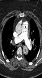The Prognostic Value of Descending Aorta to Main Pulmonary Artery Enhancement Ratio in Massive or Sub-Massive Acute Pulmonary Embolism