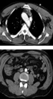 Vena Cava and Left Renal Vein Variations and Association with Other Anomalies Including Horseshoe Kidney