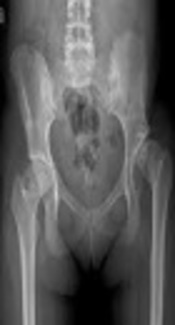 Value of Physical Examination in the Diagnosis of Developmental Hip Dislocation in Preterm Infants