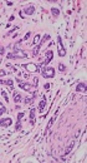Sonoelastographic Features of Major Salivary Gland Tumors and Pathology Correlation