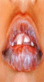 Evaluation of Salivary Endothelin1 Level in Patients with Oral Lichen Planus