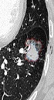 Agreement Between High-Resolution Computed Tomography and Pathological Tumor Size of Lung Adenocarcinoma: Influence of Ground Glass Opacity Ratio