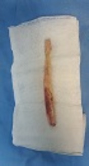 Bone-Patellar Tendon-Bone Graft Preparation for Fixation with Suspensory Method in Anterior Cruciate Reconstruction: A Biomechanical Study